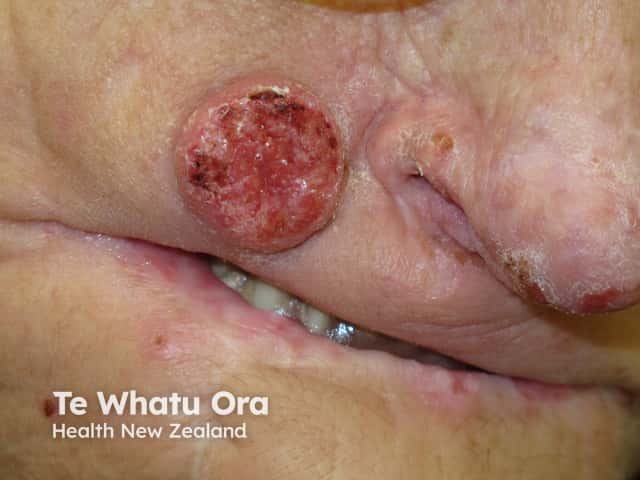 Squamous epithelioma of Ferguson-Smith