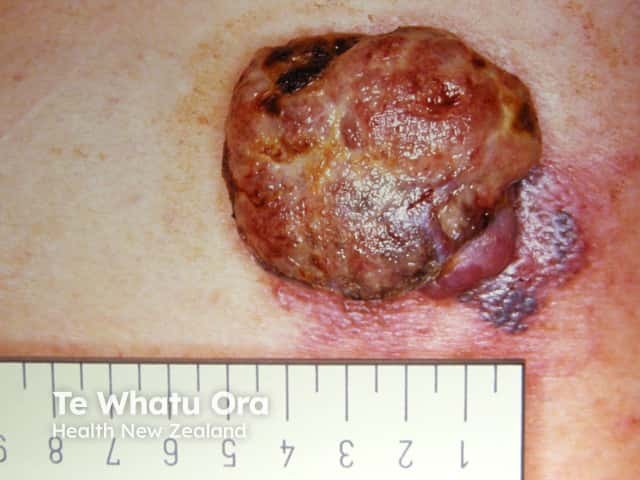 Nodular melanoma