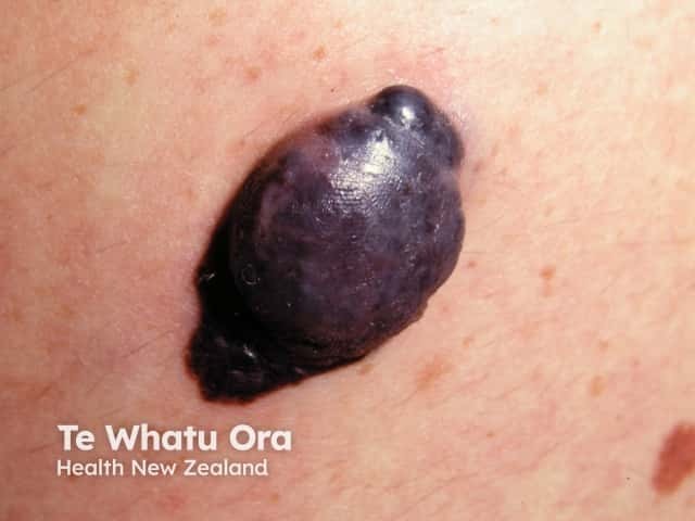 Nodular melanoma