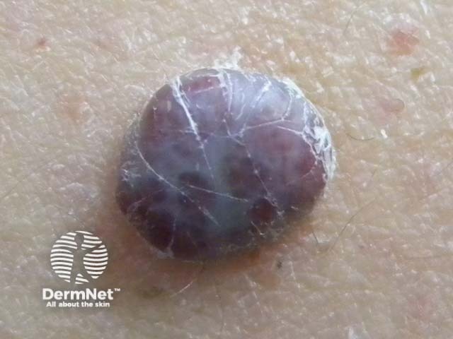 Cherry angioma