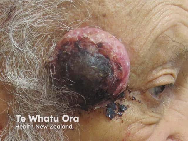 High-risk cutaneous squamous cell carcinoma