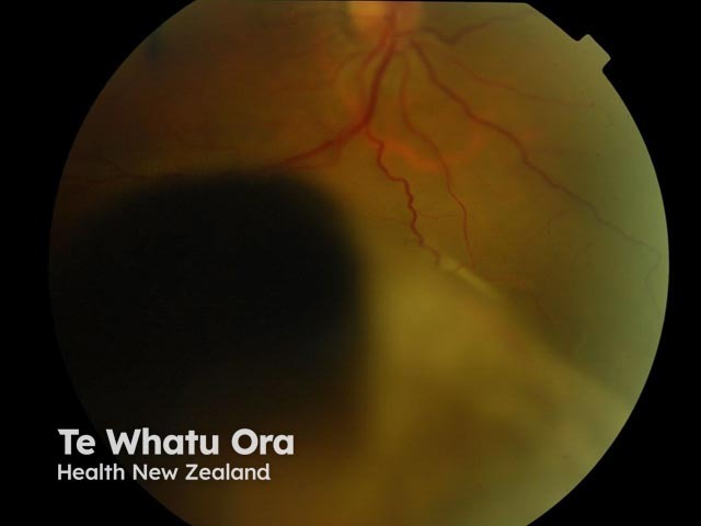 Uveal/choroidal melanoma