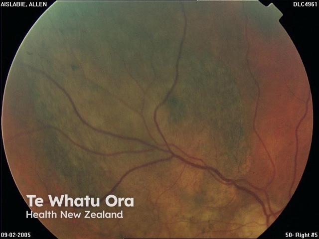 Uveal/choroidal melanoma