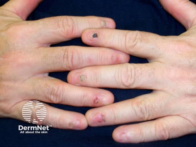 Nail dystrophy due to lichen planus