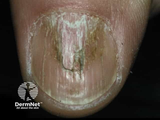 Nail dystrophy due to lichen planus