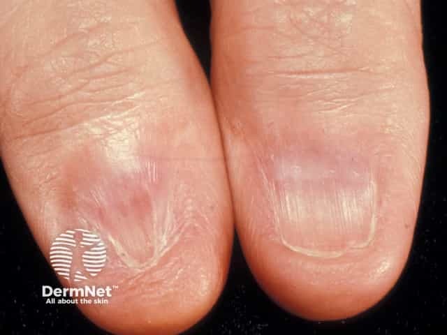 Nail dystrophy due to lichen planus