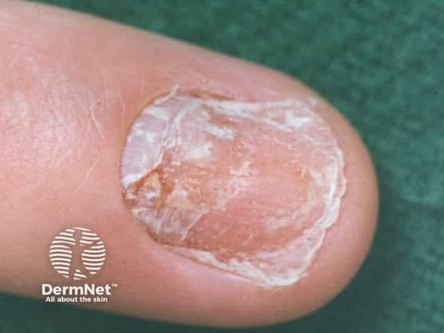 Nail dystrophy due to lichen planus