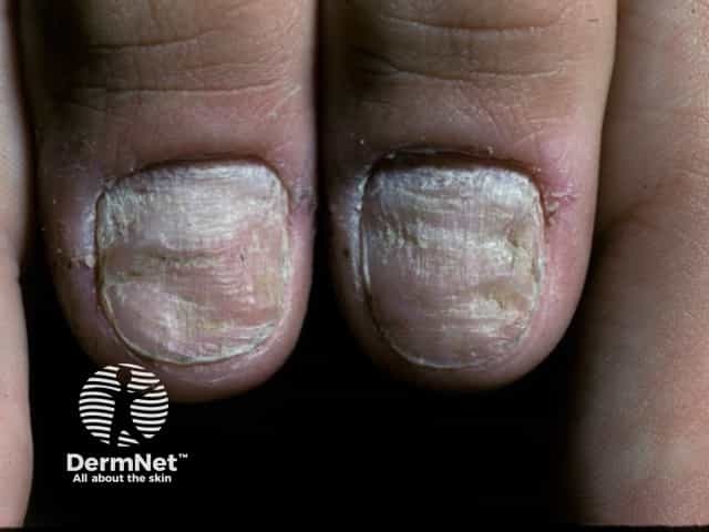 Nail dystrophy due to lichen planus