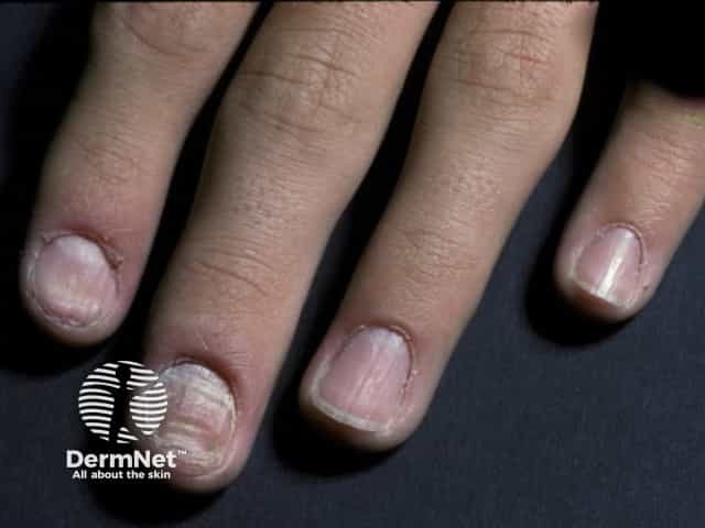 Nail dystrophy due to lichen planus