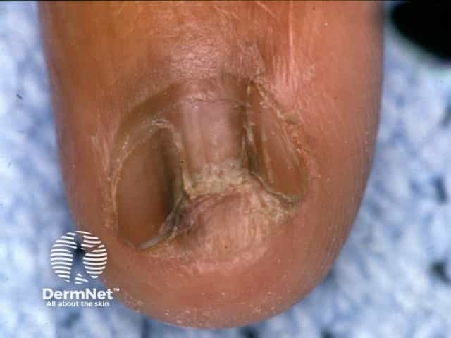 Nail dystrophy due to lichen planus