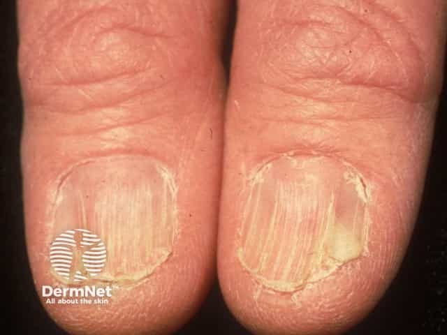 Nail dystrophy due to lichen planus