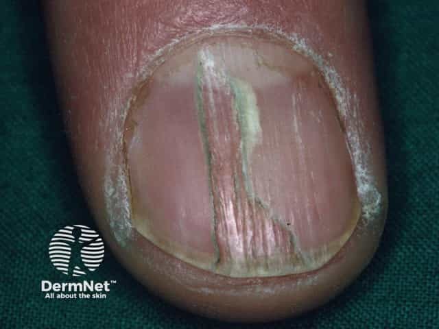 Nail dystrophy due to lichen planus