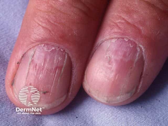 Nail dystrophy due to lichen planus