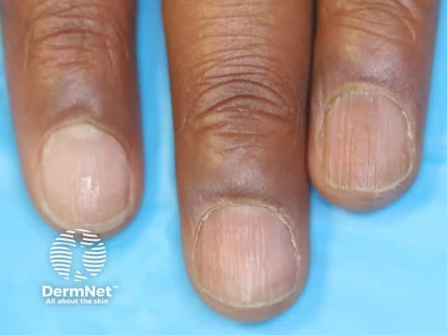 Nail dystrophy due to lichen planus