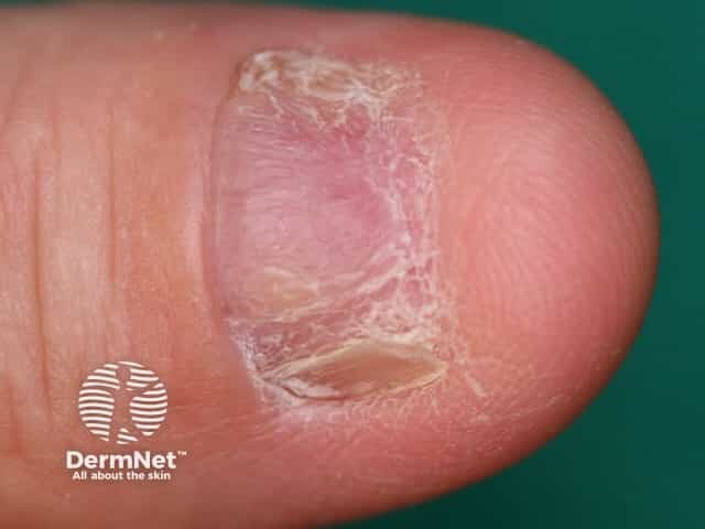 Nail dystrophy due to lichen planus