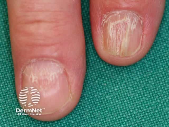 Nail dystrophy due to lichen planus