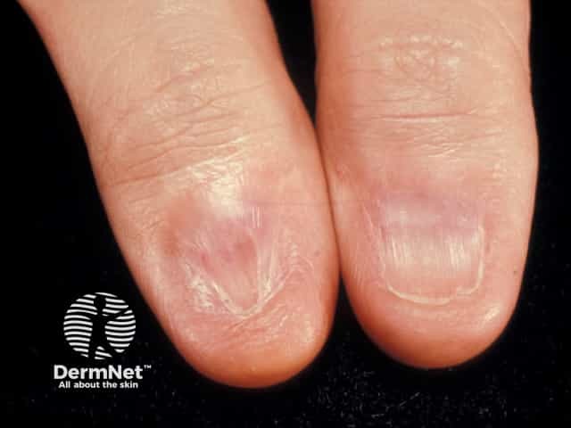 Nail dystrophy due to lichen planus