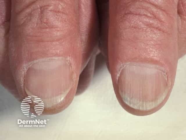 Nail dystrophy due to lichen planus