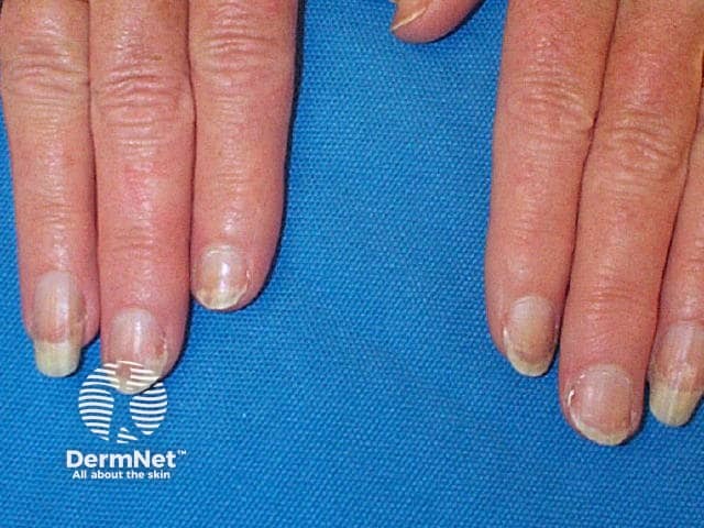 Nail dystrophy due to lichen planus