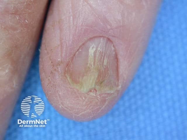 Nail dystrophy due to lichen planus