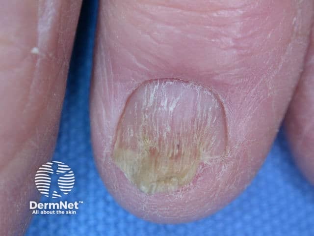 Nail dystrophy due to lichen planus