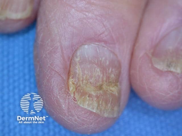 Nail dystrophy due to lichen planus