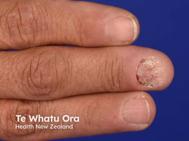 Nail dystrophy due to lichen planus