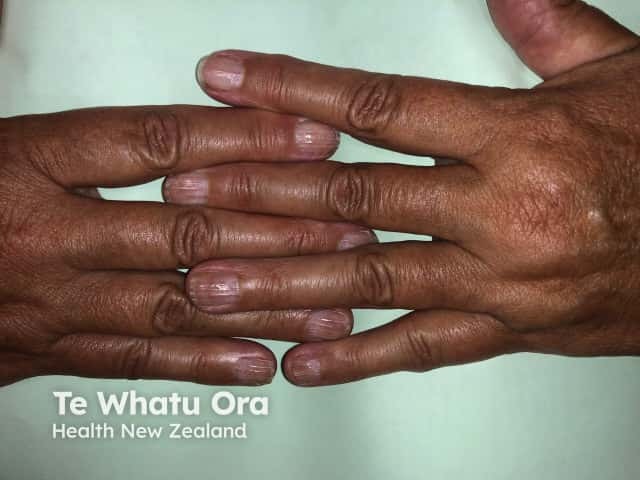 Nail dystrophy due to lichen planus