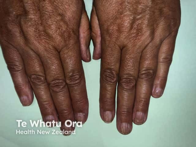 Nail dystrophy due to lichen planus