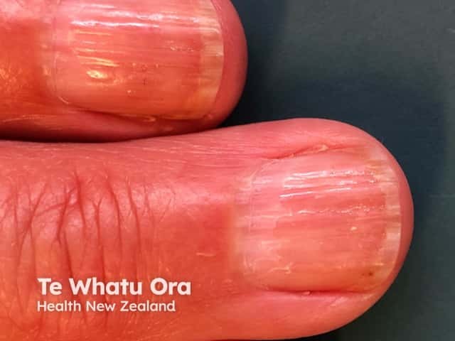 Nail dystrophy due to lichen planus