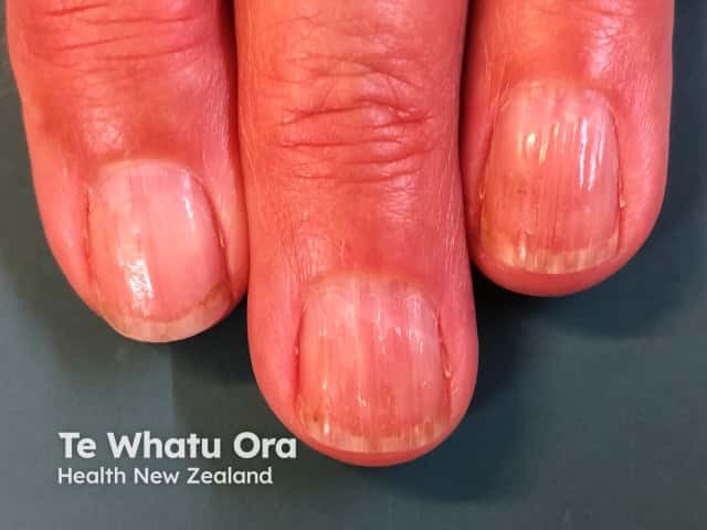 Nail dystrophy due to lichen planus