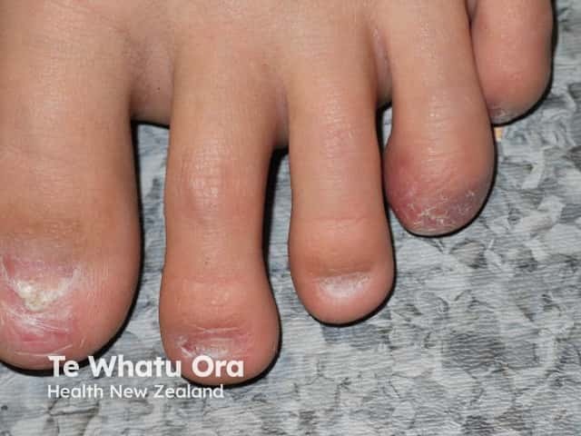 Nail dystrophy due to lichen planus