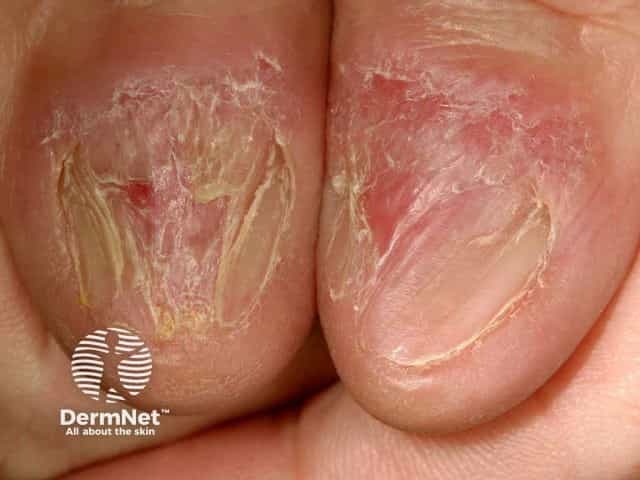 Nail dystrophy due to lichen planus