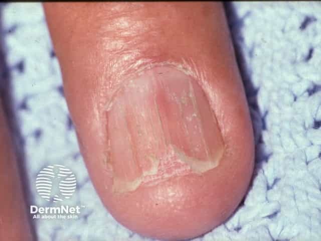 Nail dystrophy due to lichen planus