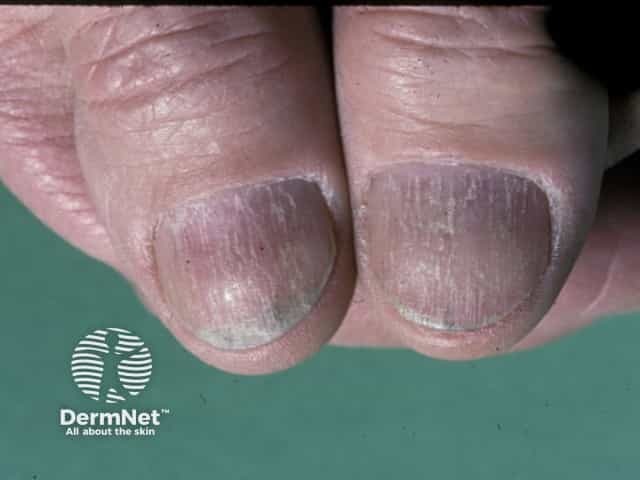 Nail dystrophy due to lichen planus