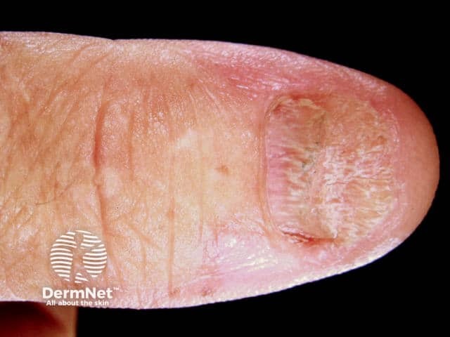 Nail dystrophy due to lichen planus