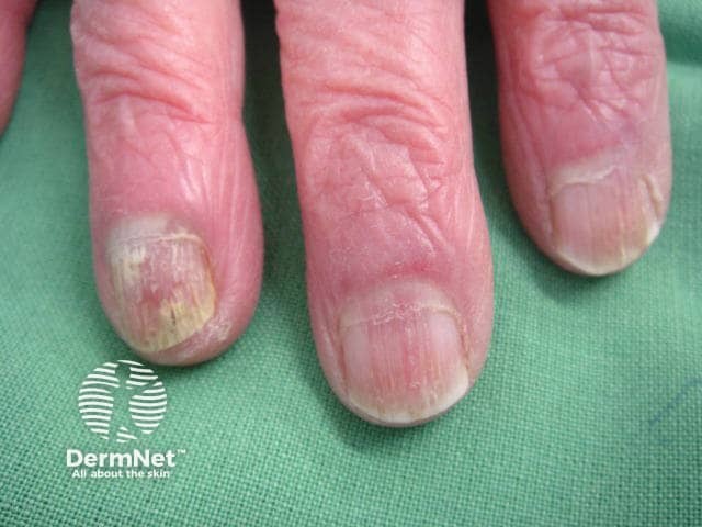 Nail dystrophy due to lichen planus