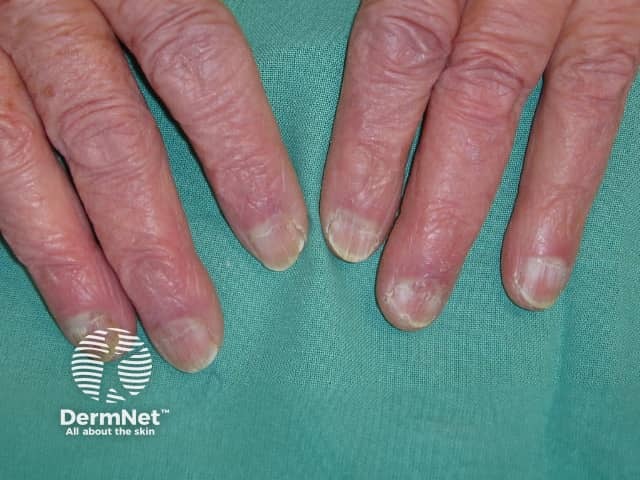 Nail dystrophy due to lichen planus