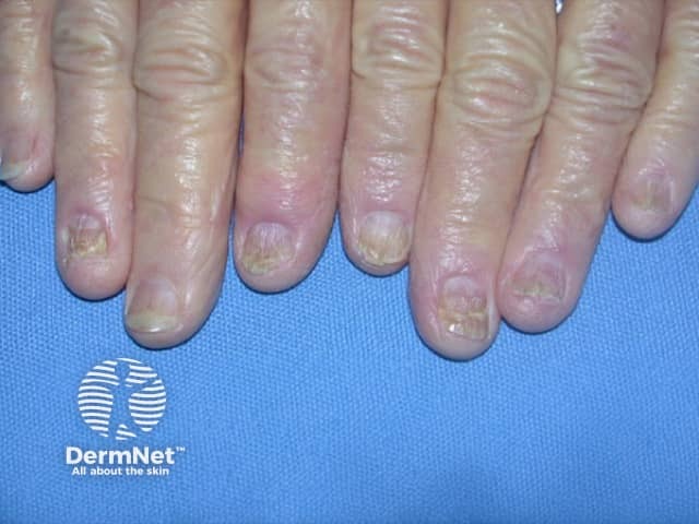 Nail dystrophy due to lichen planus