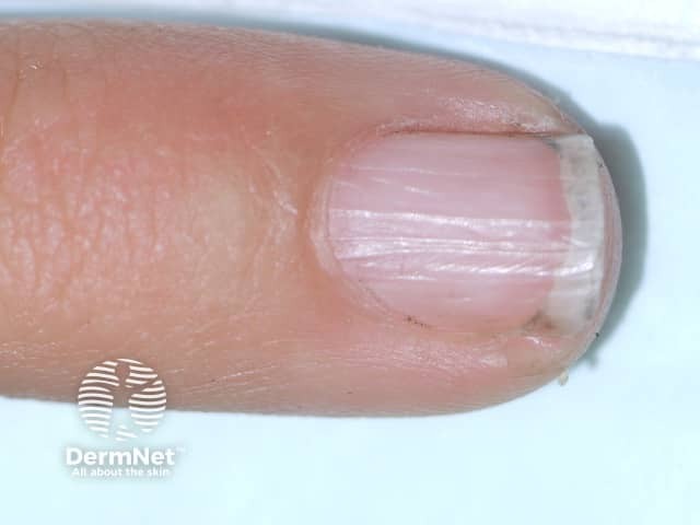 Nail dystrophy due to lichen planus