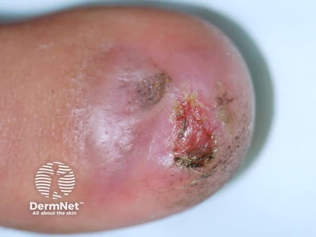 Nail dystrophy due to lichen planus