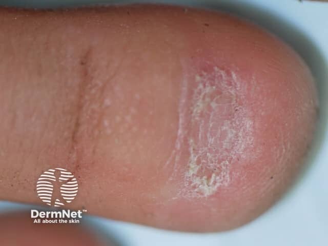 Nail dystrophy due to lichen planus