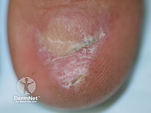 Nail dystrophy due to lichen planus