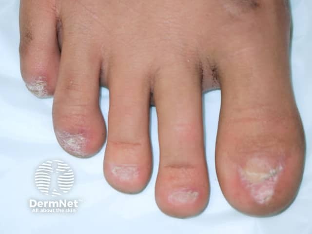 Nail dystrophy due to lichen planus