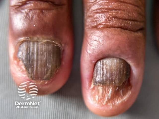 Nail dystrophy due to lichen planus