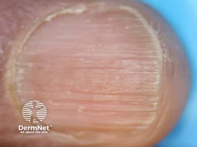 Nail dystrophy due to lichen planus