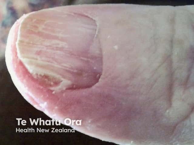 Nail dystrophy due to lichen planus