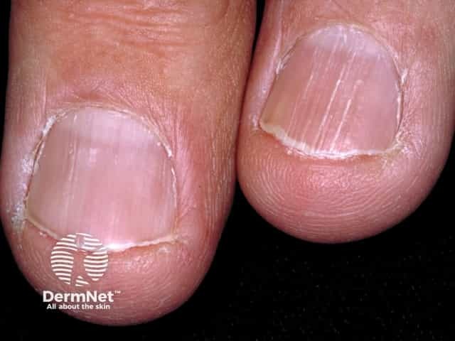 Nail dystrophy due to lichen planus