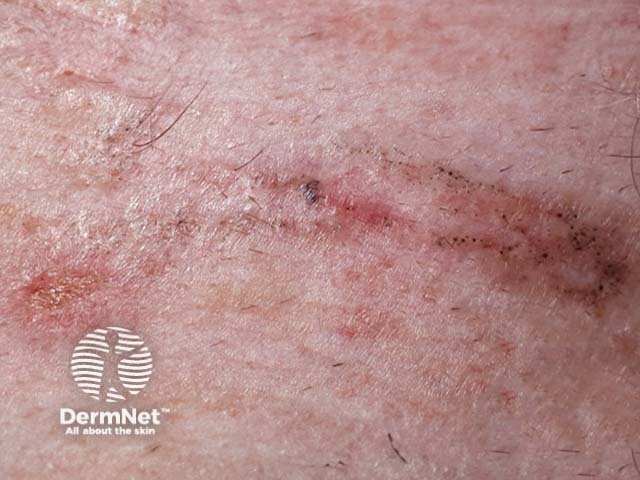 Linear pigmented basal cell carcinoma