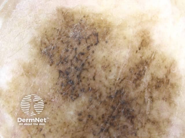 Annular granular pattern and rhomboids seen in dermoscopy of lentigo maligna melanoma